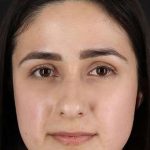 Liquid Rhinoplasty Before & After Patient #2188