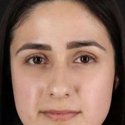 Liquid Rhinoplasty Before & After Patient #2188