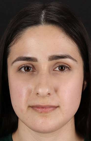 Liquid Rhinoplasty Before & After Patient #2188