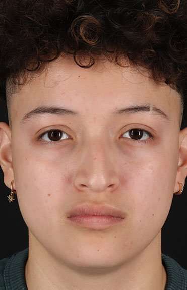 Liquid Rhinoplasty Before & After Patient #2199