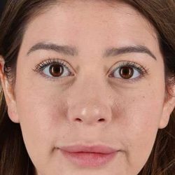 Liquid Rhinoplasty Before & After Patient #2210