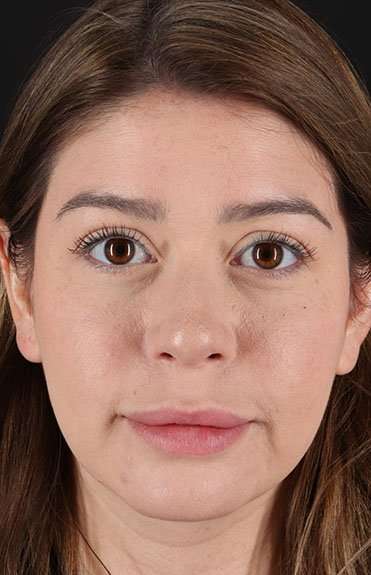 Liquid Rhinoplasty Before & After Patient #2210