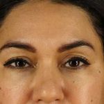 Browlift Before & After Patient #1352