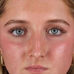Liquid Rhinoplasty Before & After Patient #2221
