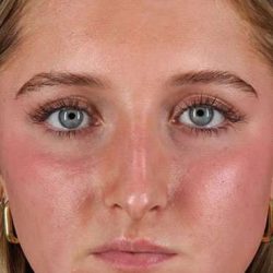 Liquid Rhinoplasty Before & After Patient #2221