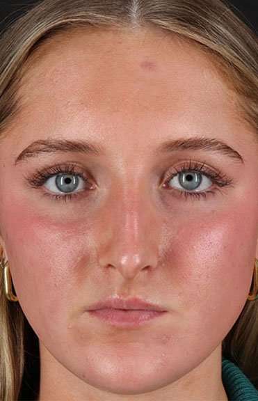 Liquid Rhinoplasty Before & After Patient #2221