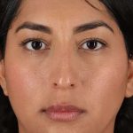 Liquid Rhinoplasty Before & After Patient #2232