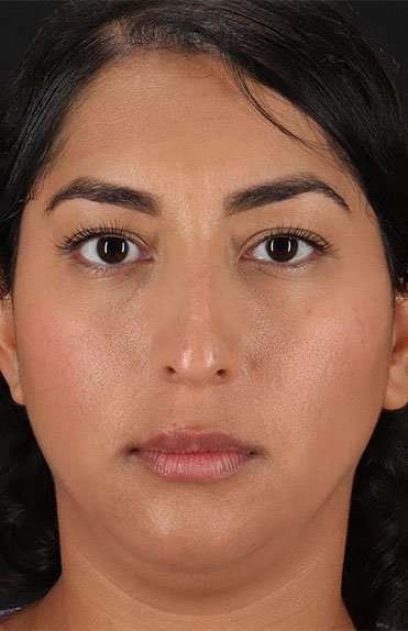 Liquid Rhinoplasty Before & After Patient #2232