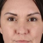 Liquid Rhinoplasty Before & After Patient #2243