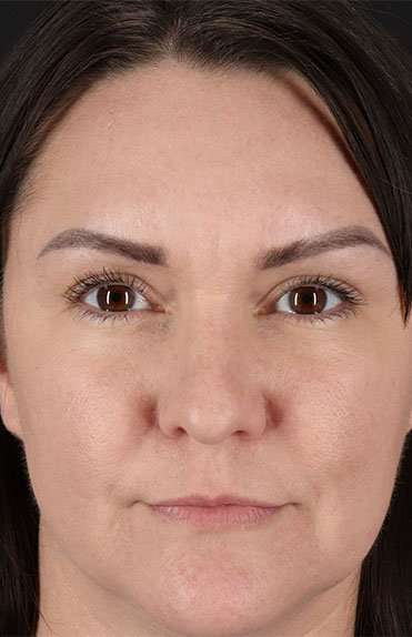 Liquid Rhinoplasty Before & After Patient #2243