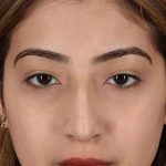 Liquid Rhinoplasty Before & After Patient #2254
