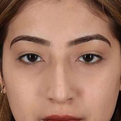 Liquid Rhinoplasty Before & After Patient #2254