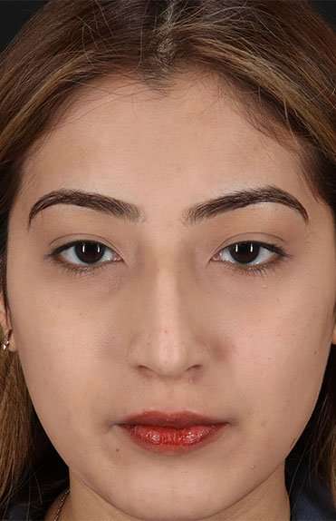 Liquid Rhinoplasty Before & After Patient #2254