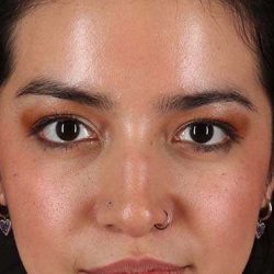 Liquid Rhinoplasty Before & After Patient #2265