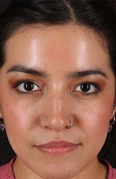 Liquid Rhinoplasty Before & After Patient #2265