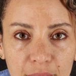 Liquid Rhinoplasty Before & After Patient #2276