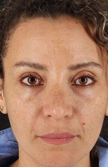 Liquid Rhinoplasty Before & After Patient #2276