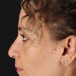Liquid Rhinoplasty Before & After Patient #2279