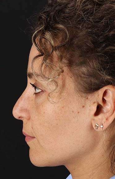 Liquid Rhinoplasty Before & After Patient #2279
