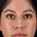 Liquid Rhinoplasty Before & After Patient #2290
