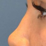Liquid Rhinoplasty Before & After Patient #2296
