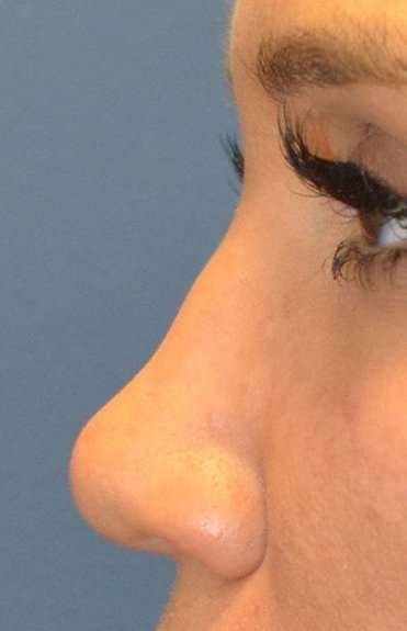 Liquid Rhinoplasty Before & After Patient #2296