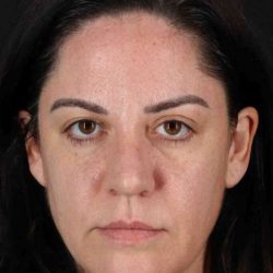 Browlift Before & After Patient #1363