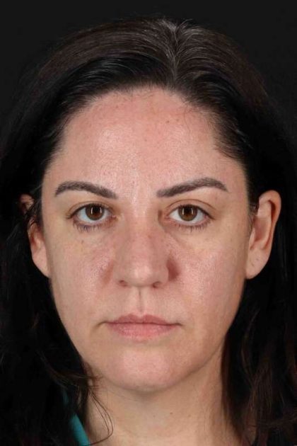 Browlift Before & After Patient #1363