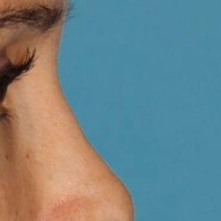 Liquid Rhinoplasty Before & After Patient #2299