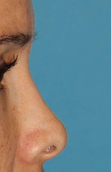 Liquid Rhinoplasty Before & After Patient #2299
