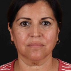 Lower Blepharoplasty Before & After Patient #2343
