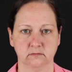 Lower Blepharoplasty Before & After Patient #2354