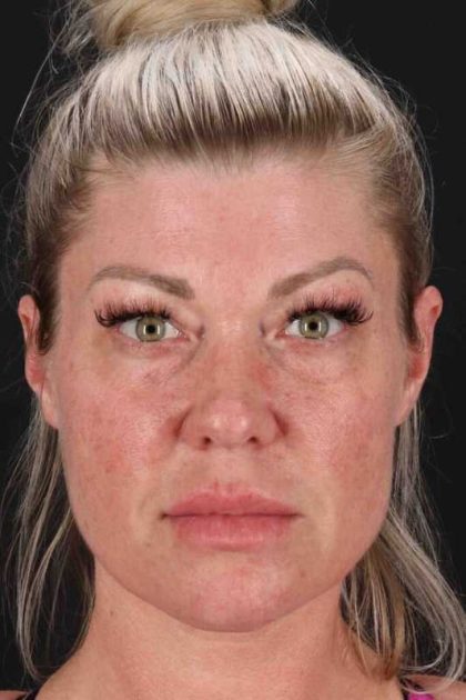 Lower Blepharoplasty Before & After Patient #2387