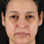 Lower Blepharoplasty Before & After Patient #2398