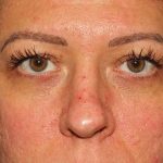Browlift Before & After Patient #1366