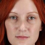 Lower Blepharoplasty Before & After Patient #2409