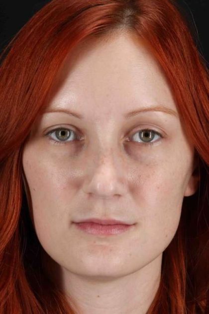 Lower Blepharoplasty Before & After Patient #2409
