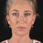 Neck Lift Before & After Patient #2441