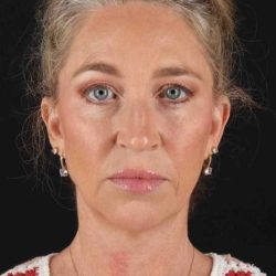 Neck Lift Before & After Patient #2441