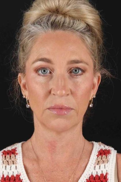 Neck Lift Before & After Patient #2441