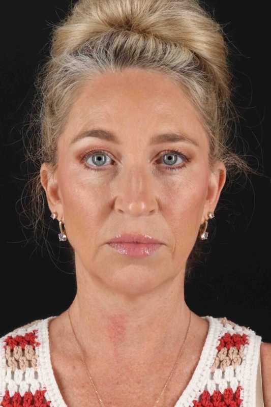 Neck Lift Before & After Patient #2441