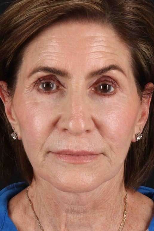 Neck Lift Before & After Patient #2452
