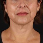Neck Lift Before & After Patient #2472