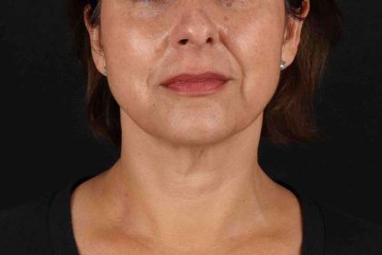 Neck Lift Before & After Patient #2472