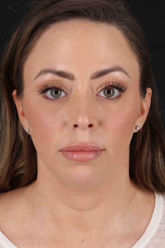 Neck Lift Before & After Patient #2505