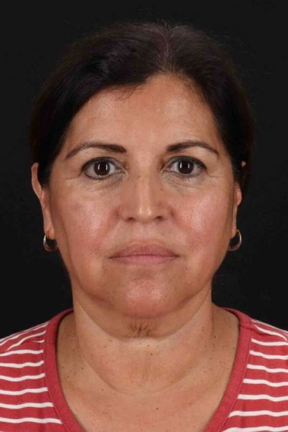 Neck Lift Before & After Patient #2516