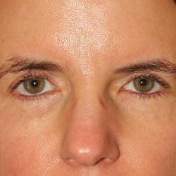 Browlift Before & After Patient #1373
