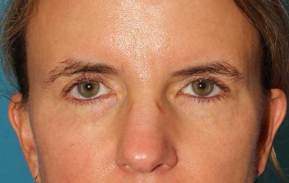 Browlift Before & After Patient #1373