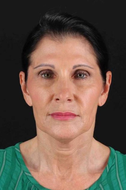 Neck Lift Before & After Patient #2538