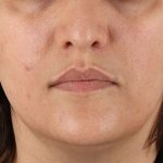 Neck Lift Before & After Patient #2560